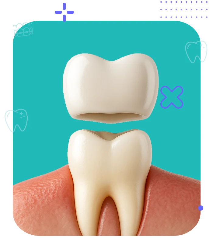 Render 3D de una corona dental sobre un diente natural con raíz visible